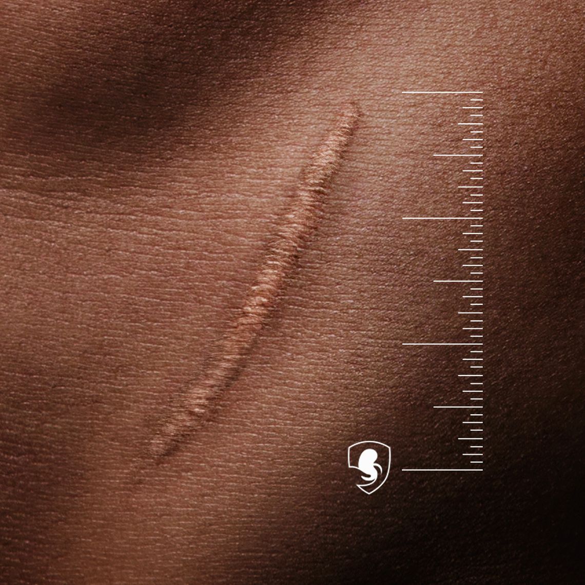 Close-up of skin with a scar, alongside a measuring scale and a logo.